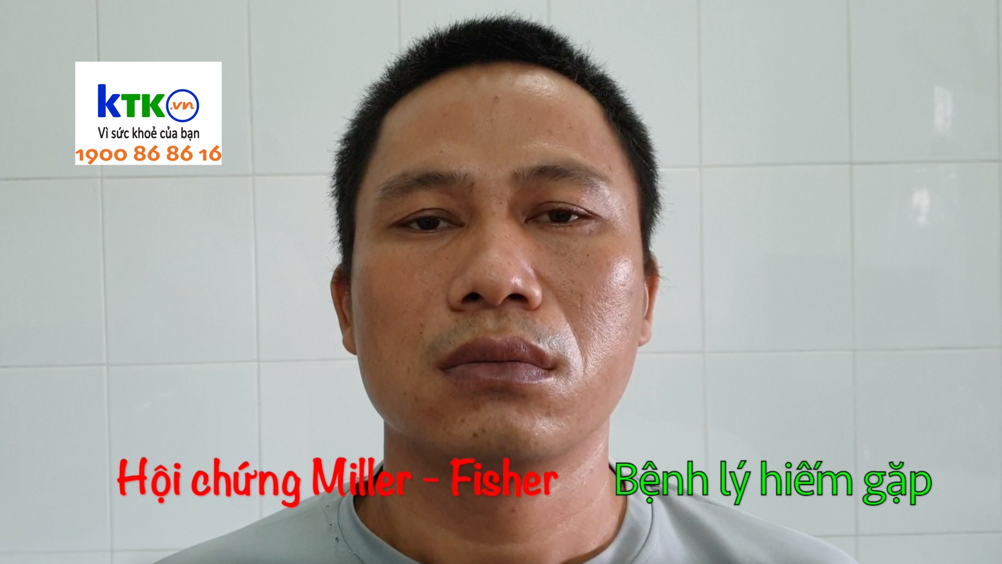 Liệt mặt hai bên ... Hội chứng Miller - Fisher.